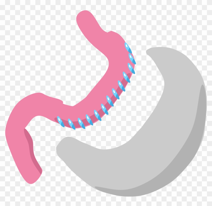 Gastric Sleeve Icon - Gastrectomy Png Clipart #4963589