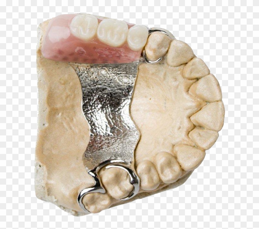 Complete & Partial Dentures, Dentures - Dental Prosthesis Clipart #503479