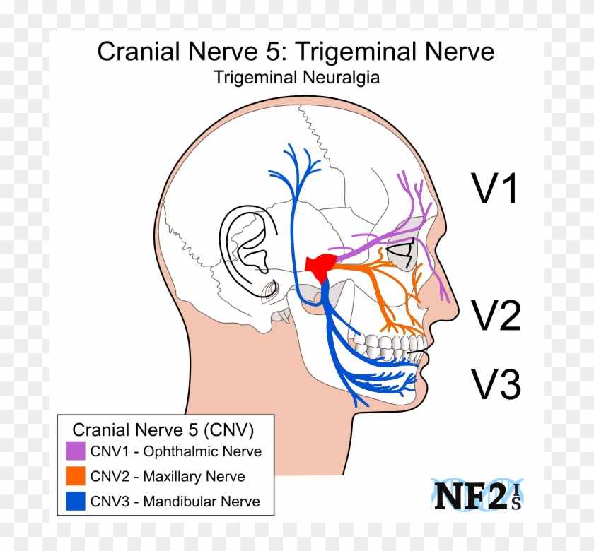Cranial Nerve 5, Subparts, 3 Branches, Branches, Filiment, - Neurofibromatosis Type Ii Clipart #5001662
