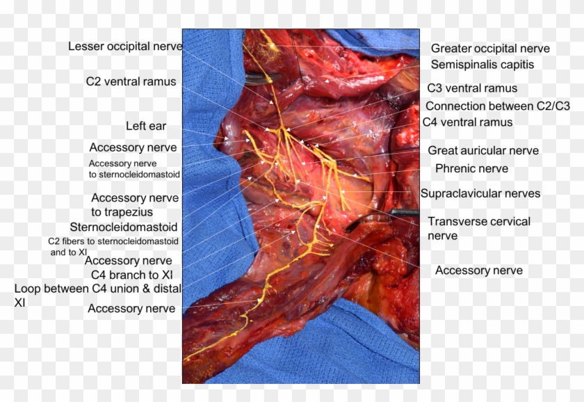 Posterior Dissection Of The Left Lateral Neck - Accessory Nerve Sternocleidomastoid Neck Dissection Clipart