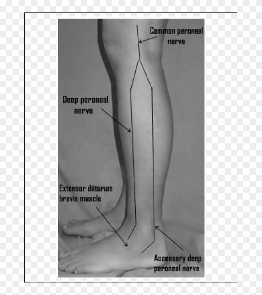 The Accessory Deep Peroneal Nerve - Stimulate Deep Peroneal Nerve Clipart
