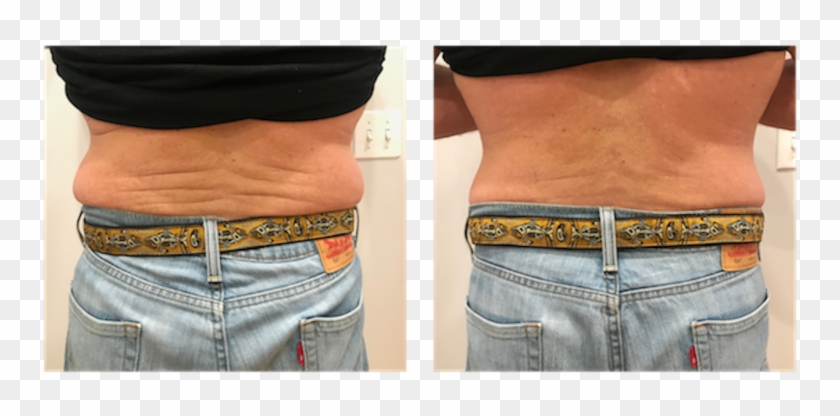 Cryoskin Before After Male 02 - Navel Clipart