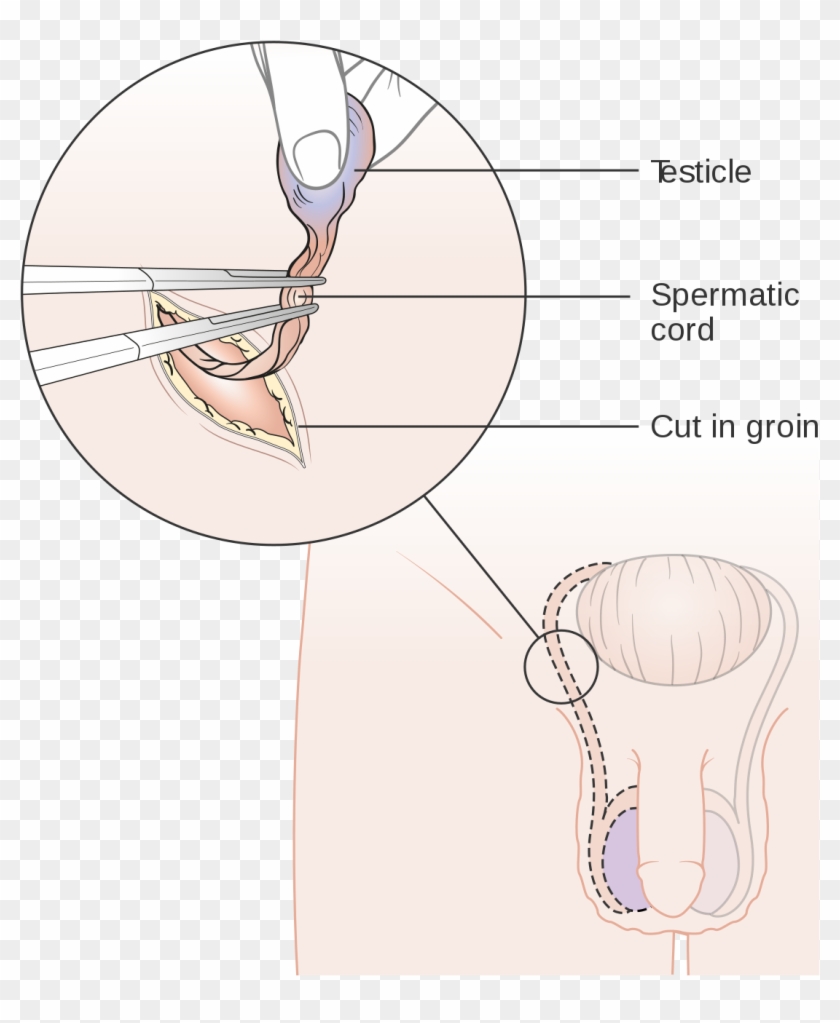 Orchiectomy - Cracked Testicle Clipart