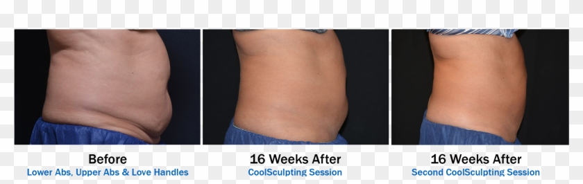 3 Picture Before And Afters For Coolsculpting Orlando-2 - Photo Caption Clipart #5003728