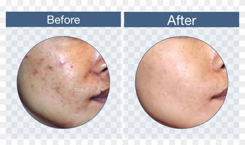 Clerogen Before & After - Freckle Clipart