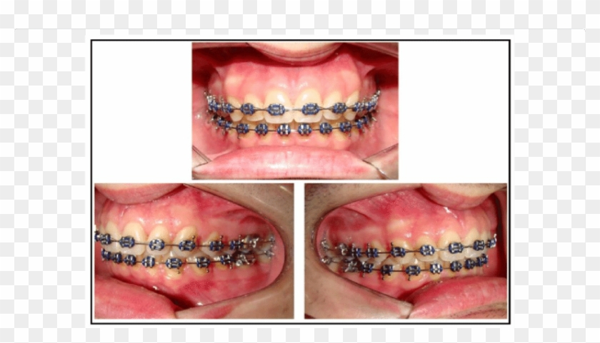 Releveling And Realignment After The End Of The Use - Macro Photography Clipart