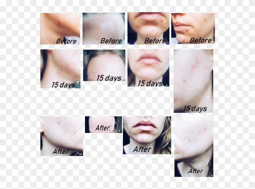 Neutrogena Light Therapy Mask Reviews Clipart