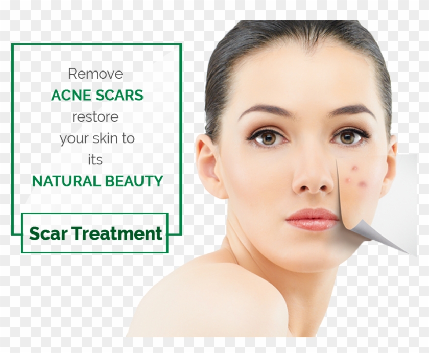 Laser Acne Scars Removal Treatment - Santa Maria Clipart #515723
