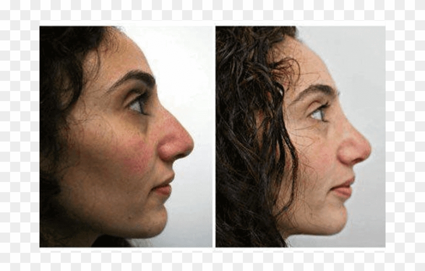 Before And After Rhinoplasty - Graphics Software Clipart