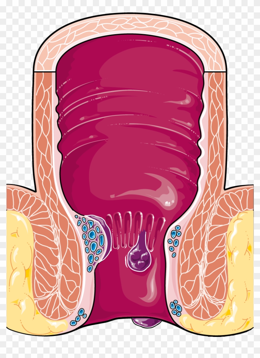 Liver Svg Png Icon Free Download - Hemorrhoids Png Clipart