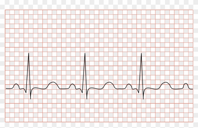 Tachycardia Ecg Paper - Amsler Grid Scotoma Clipart