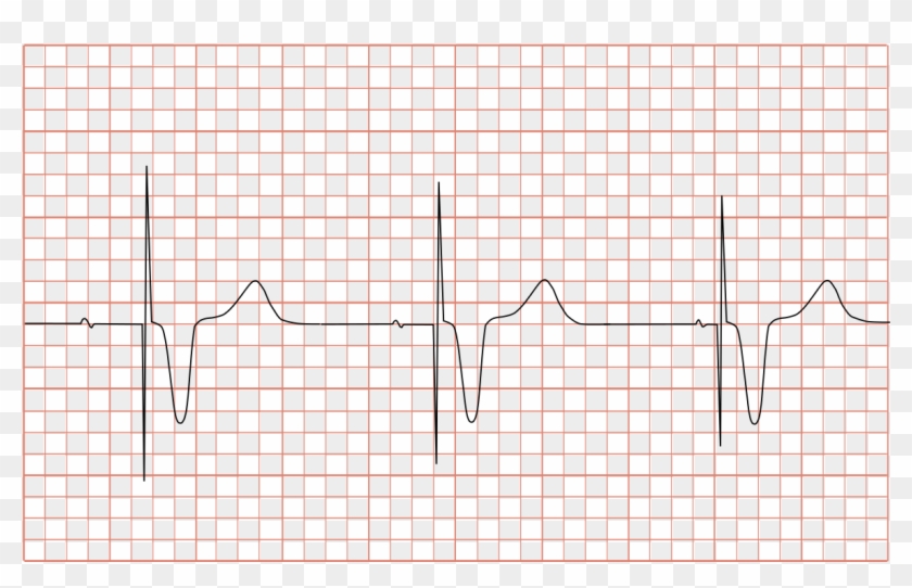 Ecg Pacemaker Syndrome - Ecg Pacemaker Clipart #5166108