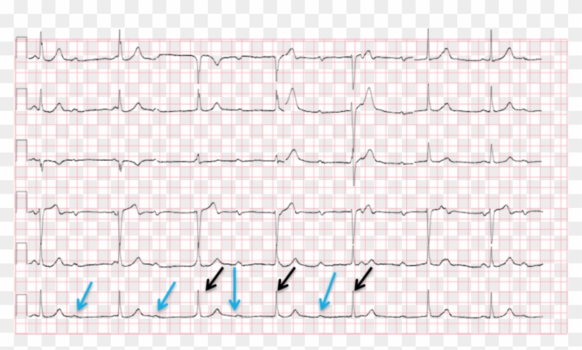 Handwriting , Png Download - Right Ventricular Conduction Delay Ecg Clipart