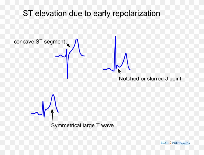 St Elevation Due To Repolarization - Concave Upward St Elevation Clipart