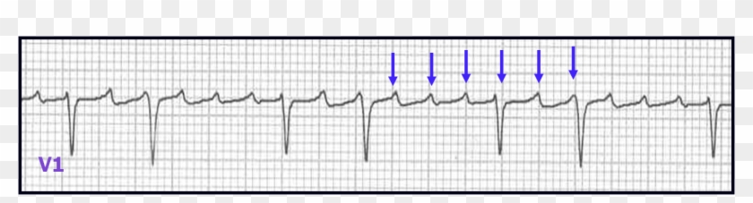Other Sv Arrythmias - Unifocal Atrial Tachycardia Clipart