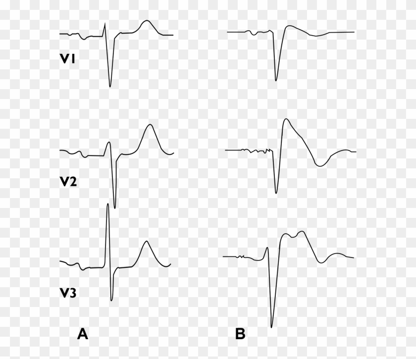 Sindrome De Brugada Sbr Canalopatias Fibrilacion For - Line Art Clipart #5167491