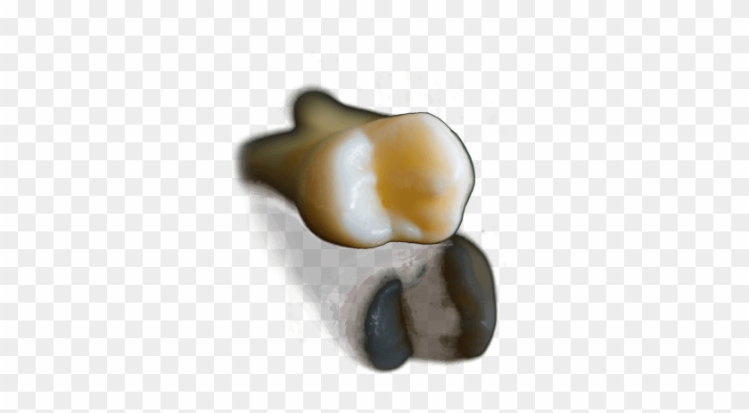 Causes & Treatment Of Tooth Erosion - Bonbon Clipart