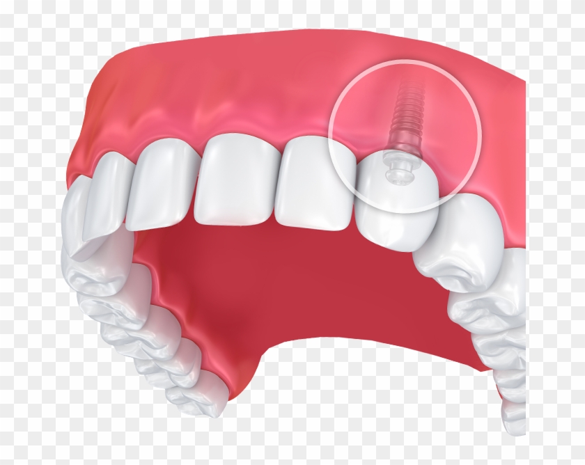 Tooth Loss Impacts The Beauty Of The Smile And Makes Clipart