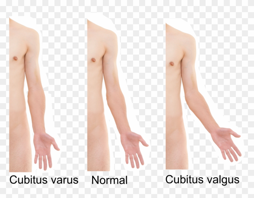 Cubitus Varus And Cubitus Valgus - Valgus Deformity Hand Clipart #5271165
