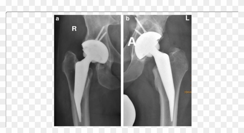 Varus And Valgus-alignement Of The Stem - Monochrome Clipart