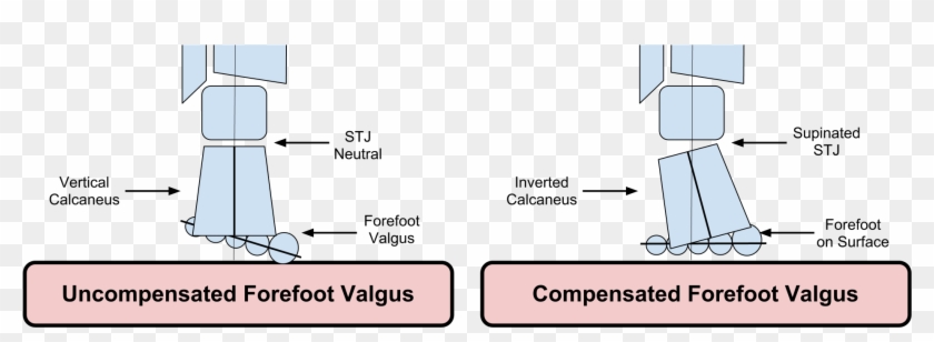 Forefoot Supinatus Clipart
