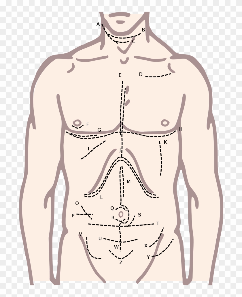Incisions Of The Torso - Upper Body Male Diagram Clipart #5275665