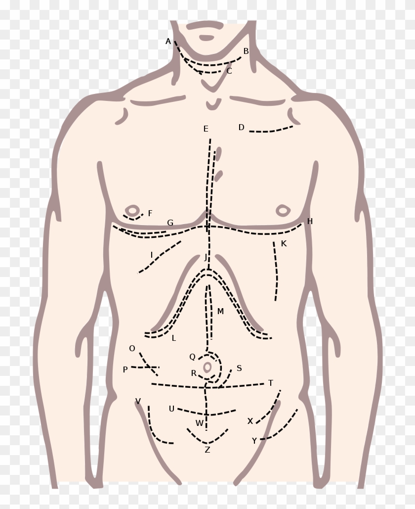 Incisions Of The Torso - Upper Body Male Diagram Clipart
