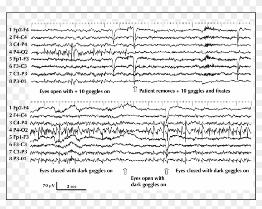Continuous Right Occipital Spiking When Eyes Are Open - Fixation Off Sensitivity In Eeg Clipart
