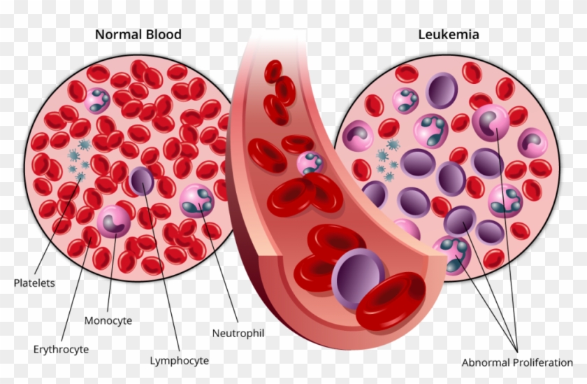 Stages Of Leukemia - Cancer Blood Clipart