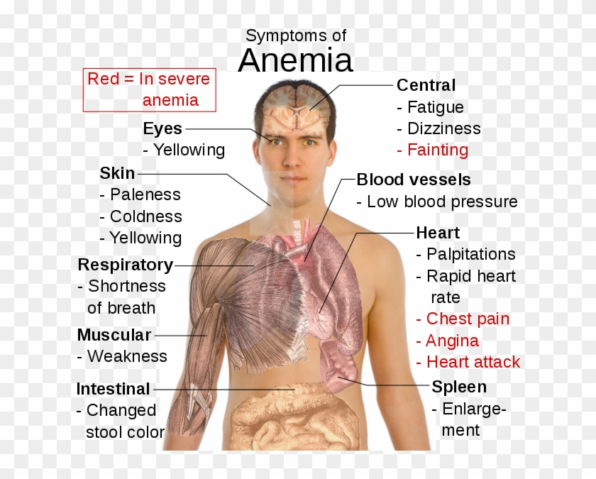 Symptoms Of Anaemia - Symptoms Of Anemia Clipart