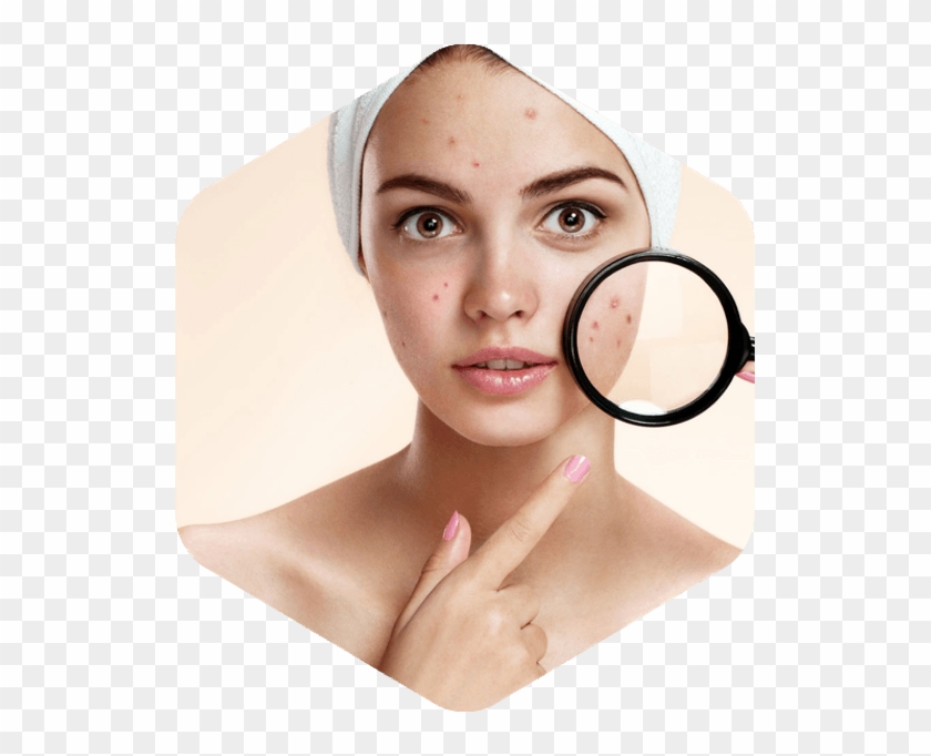 Types Of Acne Scarring - Acne Treatment Png Clipart #5481149
