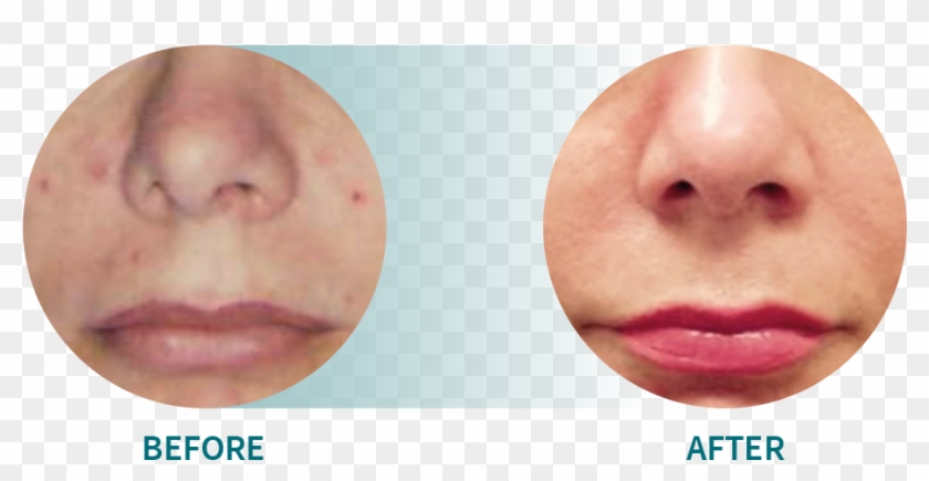 Indication - Acne - Lip Gloss Clipart #5481654