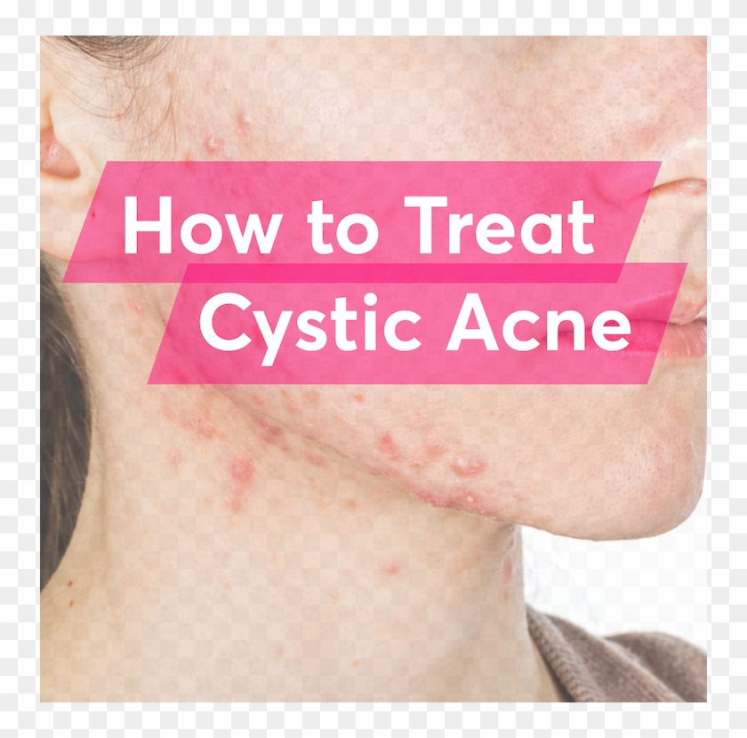 What Is The Best Treatment For Cystic Acne - Tattoo Clipart #5482138