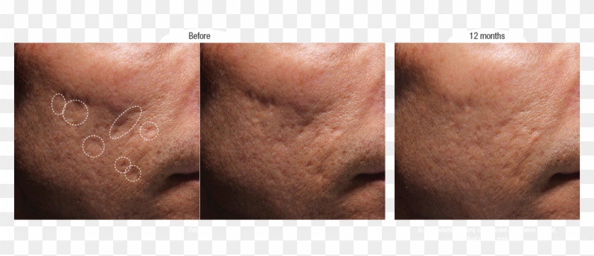 Bellafill Acne Scar Before And After Photos - Filler For Atrophic Scar Clipart #5482299