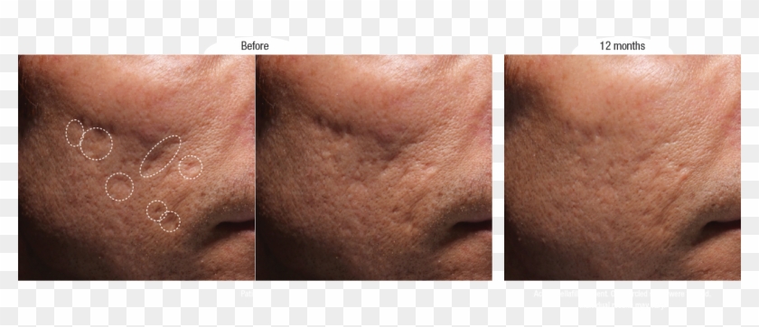 Bellafill Acne Scar Before And After Photos - Filler For Atrophic Scar Clipart