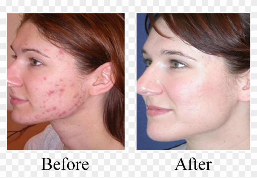 Hopkins Chiropractic Care For Acne Other Skin Conditions