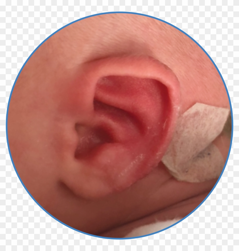 Baby Photo With Ear Buddies - Meat Clipart #5500838