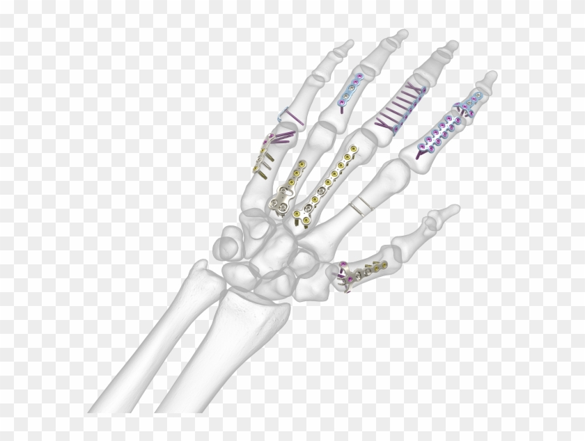 See All Images - Transparent Bone Hand Png Clipart #5505897