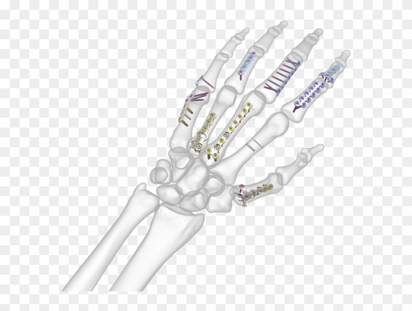 See All Images - Transparent Bone Hand Png Clipart