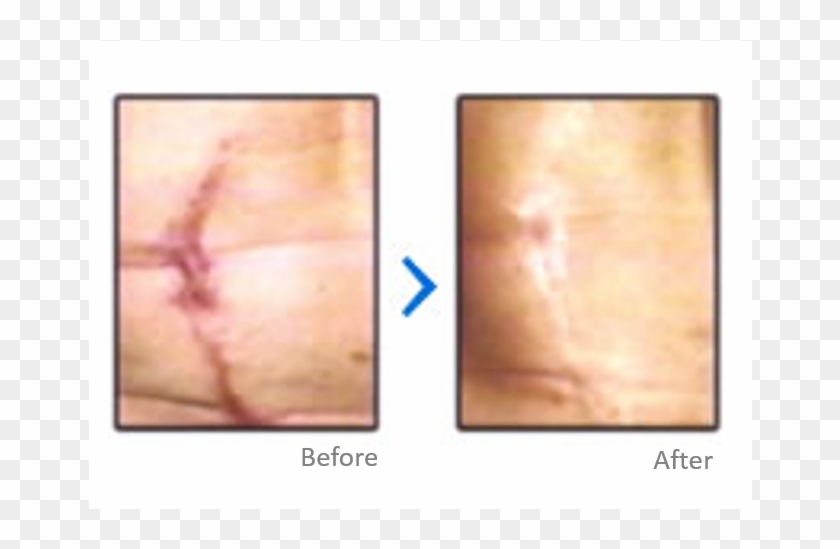 Scar Treatment Results - Plywood Clipart #5530459