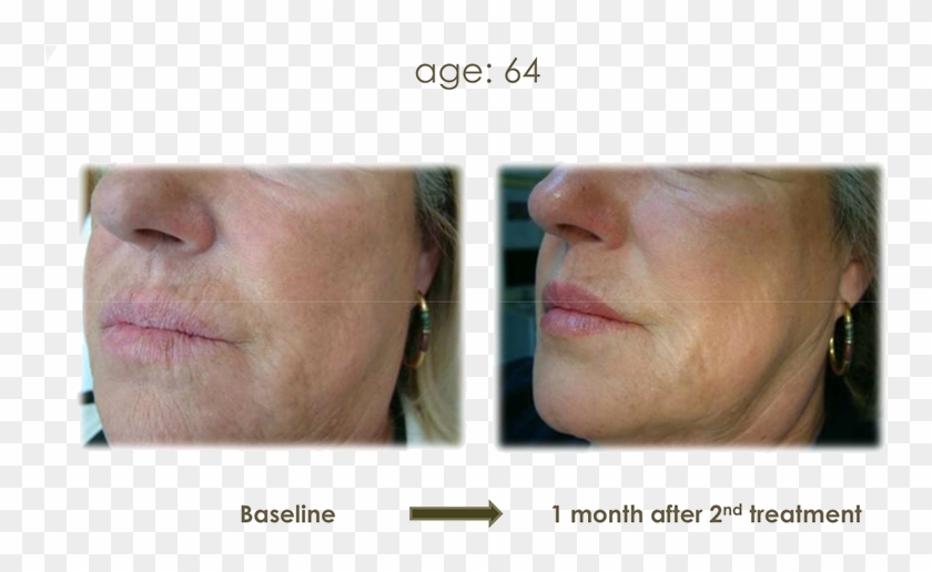 And Disperses Quickly Across The Skin To Instantly - Profhilo Neck Before And After Clipart