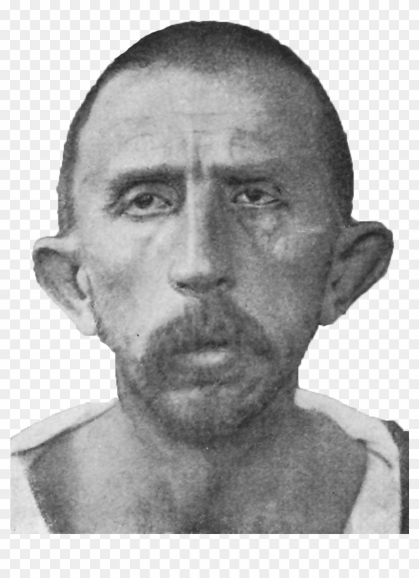 Schizophrenia Congenital Idiot, Age - Congenital Idiot Clipart