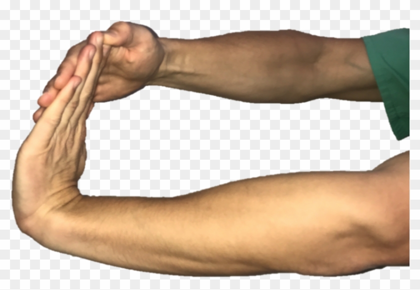 Vector Free Medial Epicondylitis Joseph J Schreiber - Bend Wrist Clipart #5591170