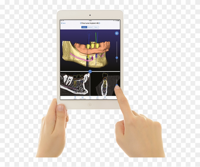 From Prosthetic To Surgical Planning - 3diemme Clipart #5622715