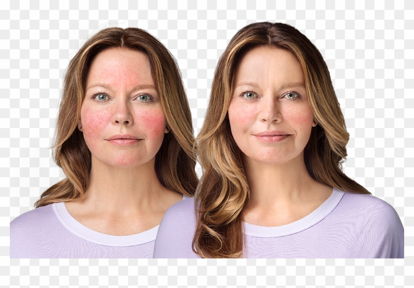 The Most Common Side Effects At The Application Site - Girl Clipart #5652034