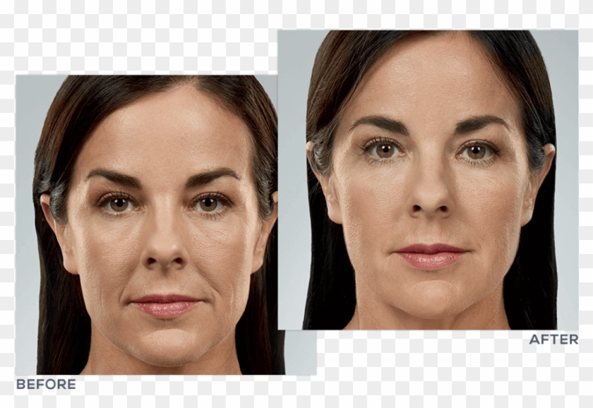 Juvéderm® Facial Filler Treatment - Juvederm Face Clipart #5660979