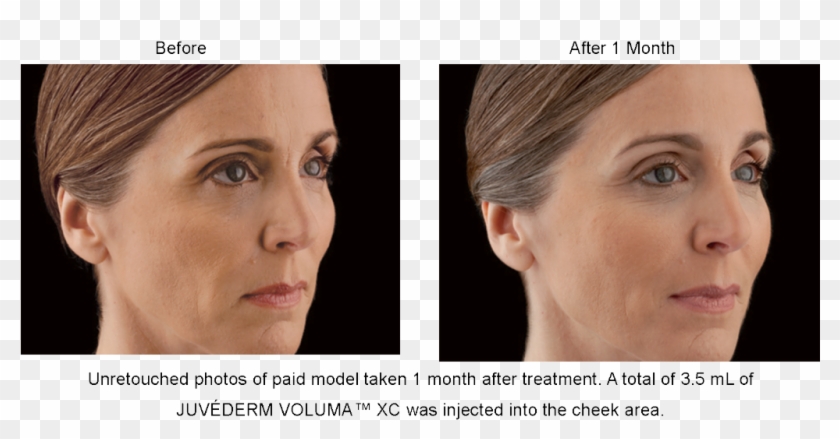 Juvederm Voluma Xc Before And After Picture - Cheek Augmentation With Fillers Before And After Clipart