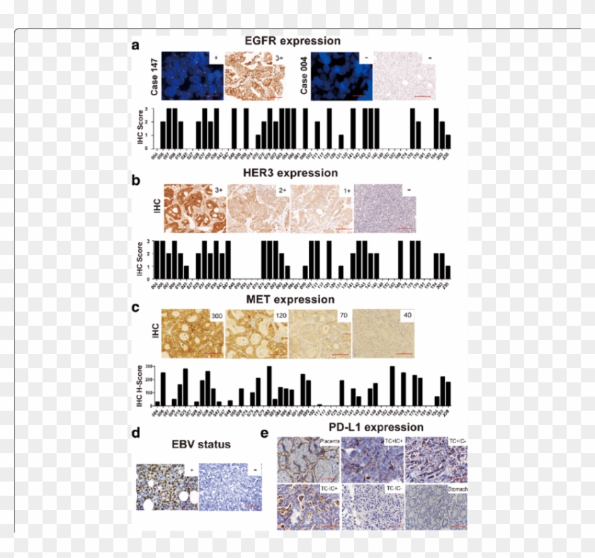 Expressions Of Several Critical Molecules In Gc Pdx - Poster Clipart #5664873