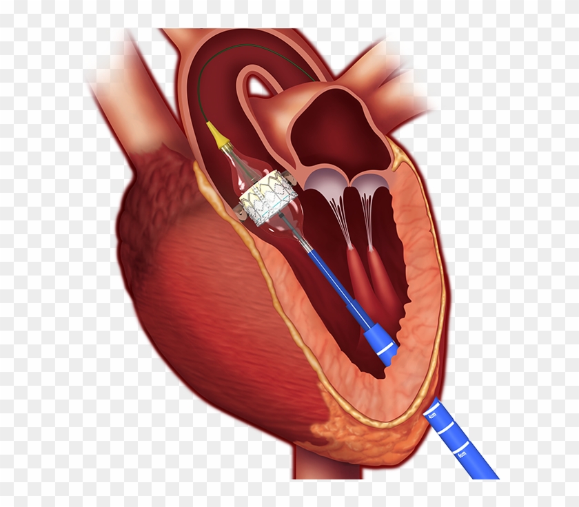 Current Team Members - Aortic Stenosis Tavi Clipart #5697611