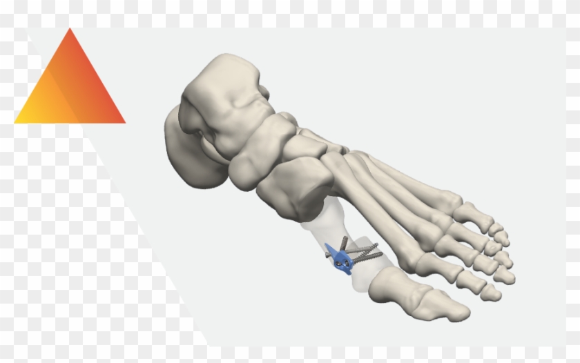 Minimally Invasive Bunion Plating System - Illustration Clipart